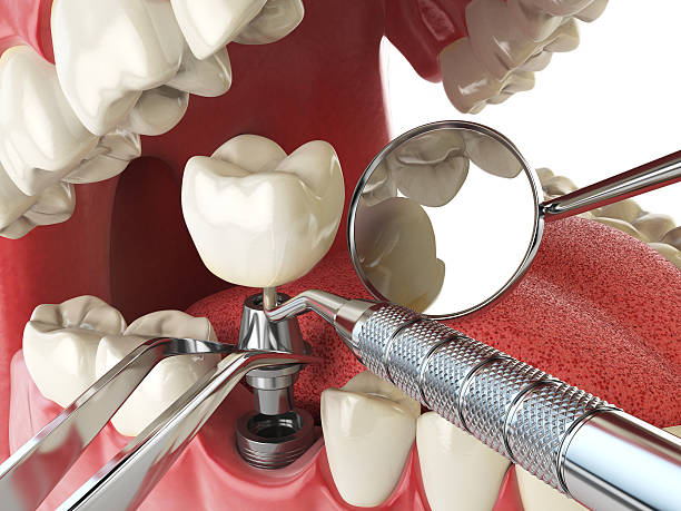 Best Emergency Tooth Extraction in Solon, OH